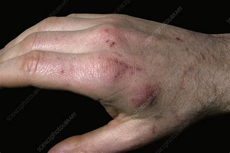 Cat scratch disease - Stock Image - C051/5374 - Science Photo Library