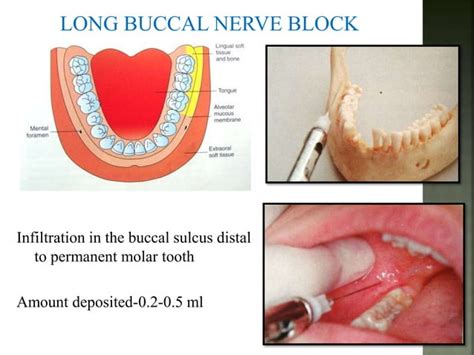 Mandibular nerve blocks techniques | PPT