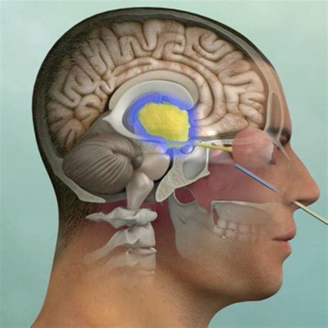 Craniopharyngioma: Symptoms, Diagnosis and Treatment | Pacific ...