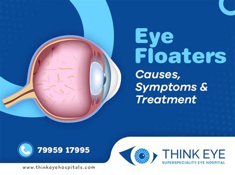 Eye Floaters Treatment in Hyderabad | Think Eye Hospitals