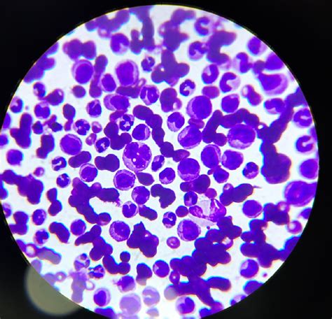 PERIPHERAL SMEAR EXAMINATION