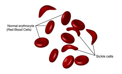 Sickle Cell Anemia - The Medical Biochemistry Page