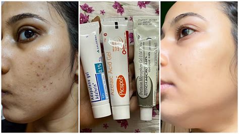 Best Pimple Creams Acne Scar Removal Creams| Nykaa's Beauty Book ...