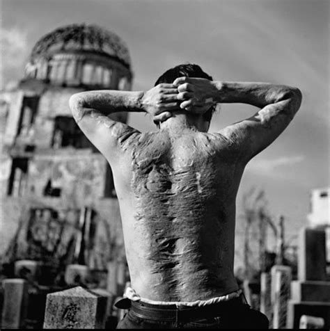 A photograph of a Hiroshima survivor’s body. : r/Damnthatsinteresting