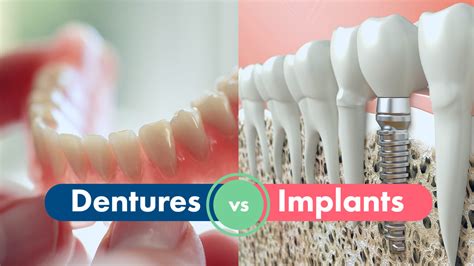 Different Types Of Dental Implants: A Detailed Guide | Byford Smiles ...