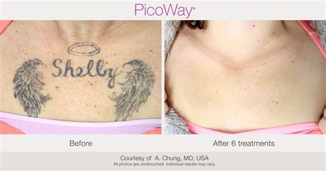 PicoWay Laser Tattoo Removal – Synergy Medical Aesthetics – Nanaimo ...