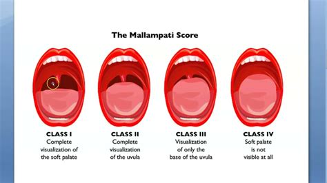 Anesthesia Mallampati score grading MP Airway Evaluation Open mouth ...