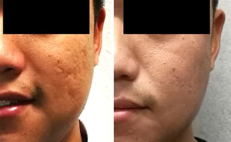 Acne Scar Removal Treatment in Singapore - Get rid of them forever - Dr ...