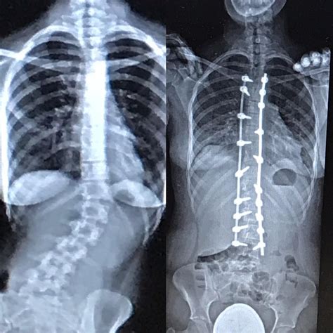 Before and after pics from my surgery (6/26/19) : scoliosis