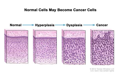 Definition of hyperplasia - NCI Dictionary of Cancer Terms - NCI