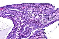 Cervical polyps - Libre Pathology