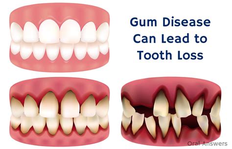 Periodontal Disease – Not Cavities – Is the Leading Cause of Tooth Loss ...