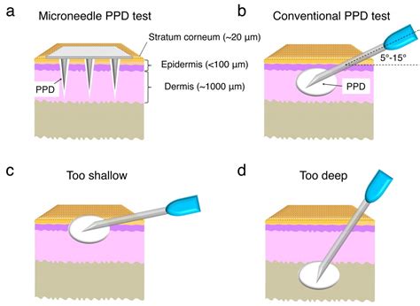 Microneedle patch could replace standard tuberculosis skin test | UW News