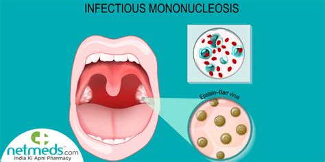 Mononucleosis: Causes, Symptoms And Treatment