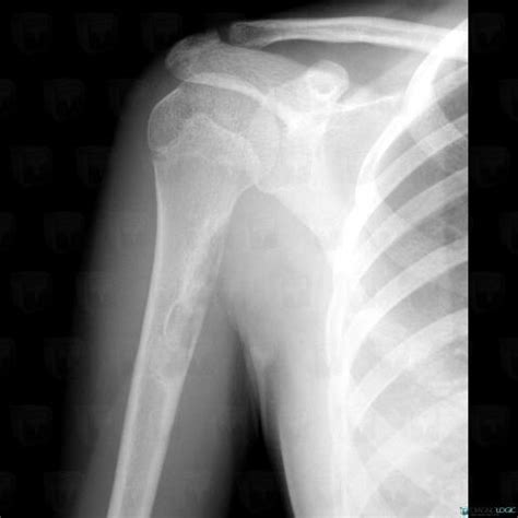 Radiology case : Osteosarcoma (X rays) - Diagnologic