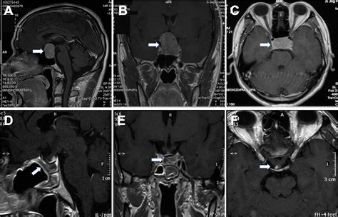 Frontiers | Pseudocapsule-Based Resection for Pituitary Adenomas via ...