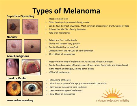 Superficial Spreading Malignant Melanoma