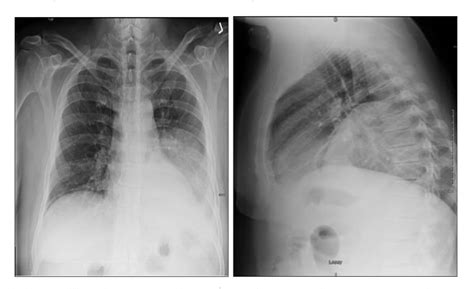 Figure 1 from Lung abscess caused by Streptococcus intermedius in an ...