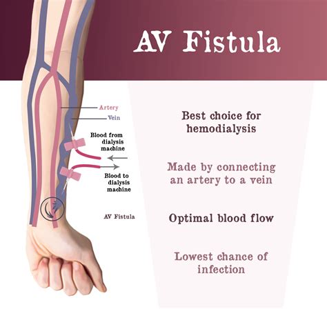 Hemodialysis Access - Gaytri Manek (Formerly Gandotra), MD