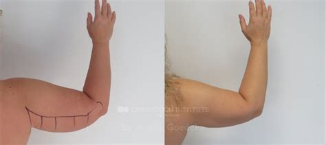 Arms - The Liposuction Institute