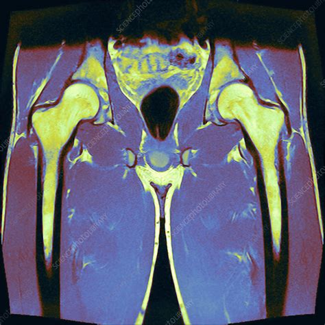 Healthy male hips, MRI scan - Stock Image - P116/0826 - Science Photo ...