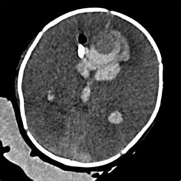 Cerebral Aneurysm Ct