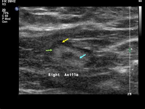 Atlas of breast cancer early detection