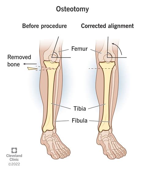 Osteotomy (Bone Cutting): What It Is, Procedure & Recovery