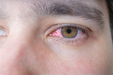 Blut im Auge – Ursachen, Symptome und Therapie – Naturheilkunde ...