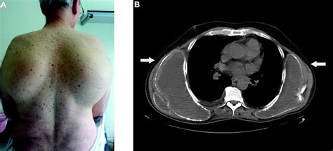 Subscapular Bursitis and Calcinosis in a Patient With Dermatomyositis ...