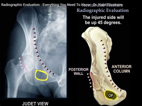 Radiographic Evaluation of Acetabular Fractures — OrthopaedicPrinciples.com