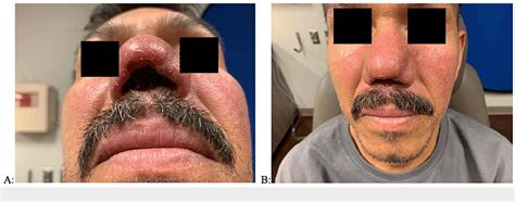 Figure 1 from Clinical Diagnosis and Management of Mucosal ...