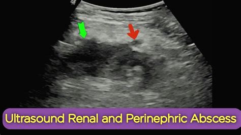 Ultrasound Renal + Perinephric Abscess - YouTube