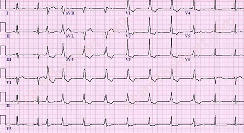 Accelerated Idioventricular Rhythm (AIVR) or slow VT ECG Example ...