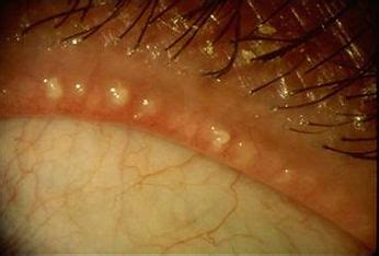 Meibomian Gland Dysfunction (MGD) - Dry Eye Center