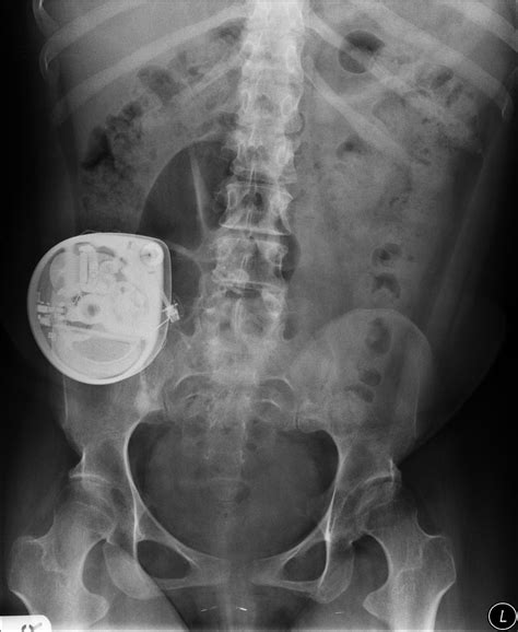 Baclofen pump | Image | Radiopaedia.org