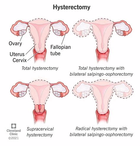 Supracervical Hysterectomy - New York Gynecology Surgery