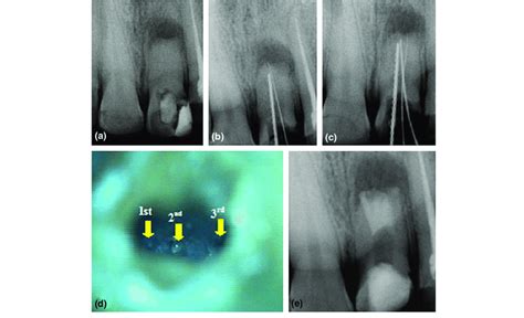 Maxillary central incisor with three root canals. (a) Preoperative ...