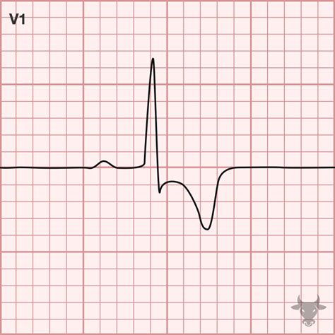 Right Heart Strain | ECG Stampede