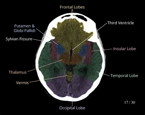 Anatomy Of The Brain And Face: Labeled CT E-Anatomy, 49% OFF