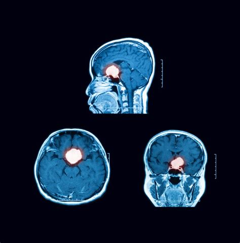 Acromegaly Diagnosis