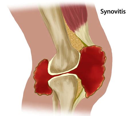 What is Synovitis? > Untreated Bleeding in the Joints > Complications ...