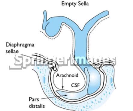 Sella Turcica - Bone, Function, Site, Location, Anatomy, Empty Sella