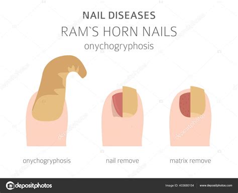 Onychogryphosis Causes