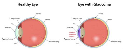 Glaucoma: 10 Facts Everyone Should Know - Optix Eye Care