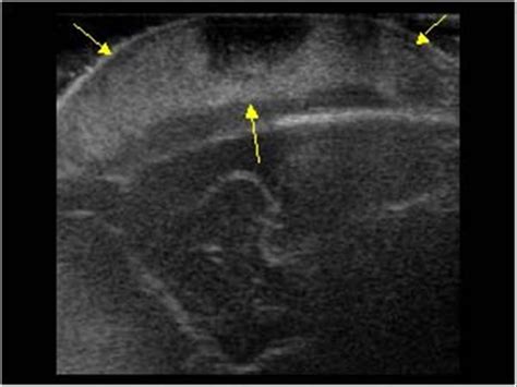 Pediatrics | 9.5 Pediatric head and neck : Case 9.5.3 Skull and extra ...