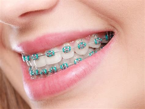 The Benefits Of Orthodontic Treatment For Your Oral Health - cypruswell