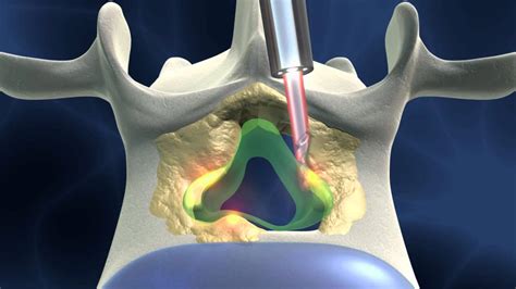 Full-endoscopic spinal surgery for spinal stenosis; dorsal approach ...