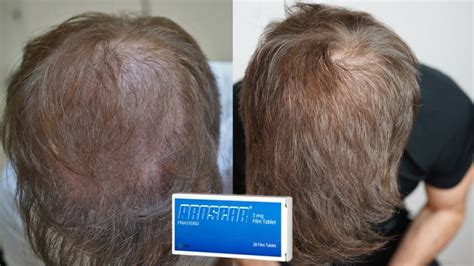 My Finasteride Results After 1 Year | Matt Dominance Finasteride Progress