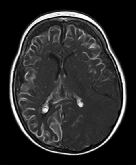 Leptomeningeal Angiomas